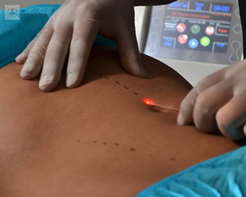 liposuccion-por-laser-o-lipolaser imagen de artículo