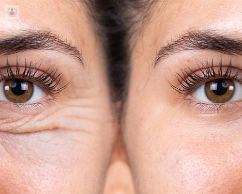 Surgery of the eyelids, eye bags and chants: blepharoplasty