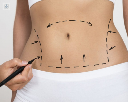abdominoplastia-o-lipectomia-de-abdomen imagen de artículo
