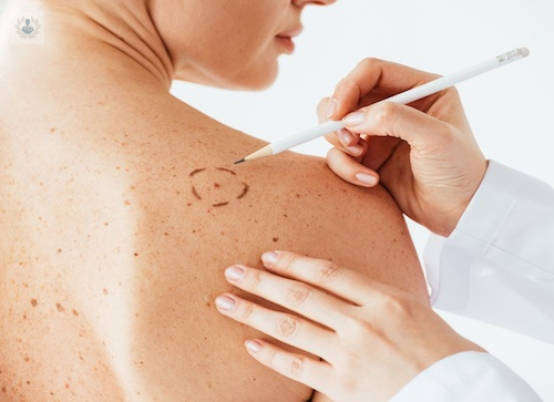 tratamiento-de-manchas-y-lesiones-pigmentadas-con-laser imagen de artículo