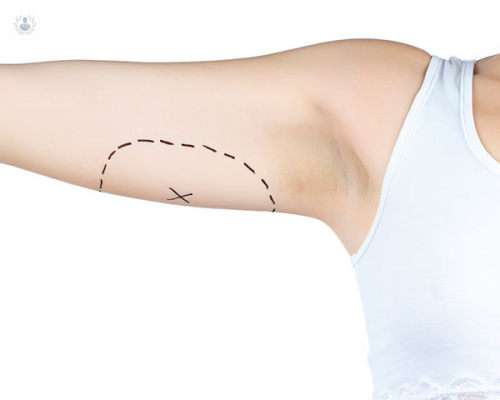 Arm Lift: Brachioplasty