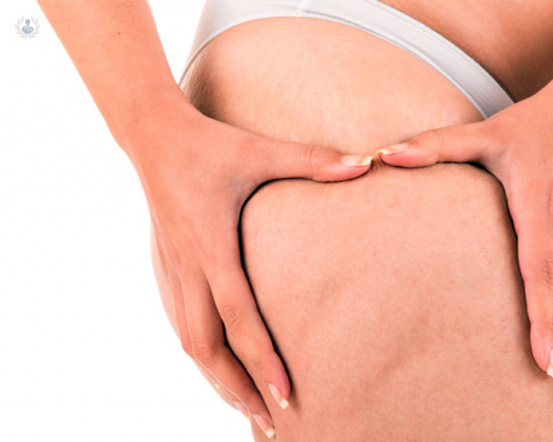 tratamiento-de-la-celulitis imagen de artículo