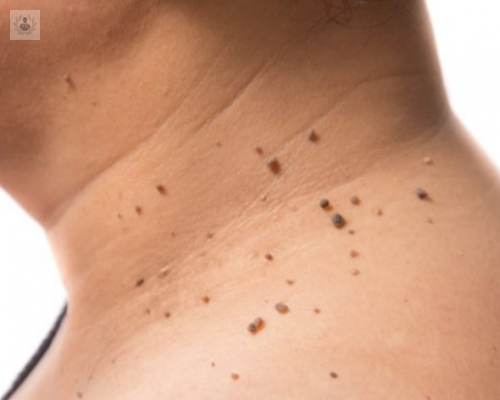 tratamiento-de-hongos-parasitos-verrugas imagen de artículo