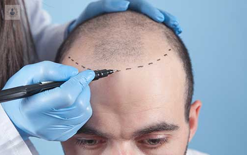 trasplante-de-cabello imagen de artículo