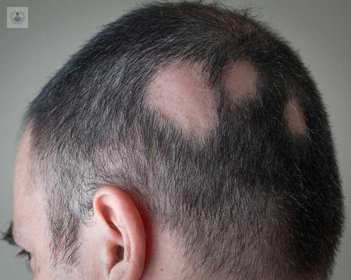 Alopecia: causa y tratamiento