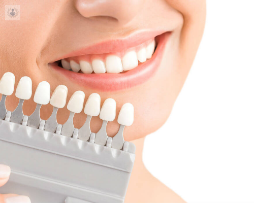 recubrimiento-de-dientes-con-carillas-o-coronas imagen de artículo