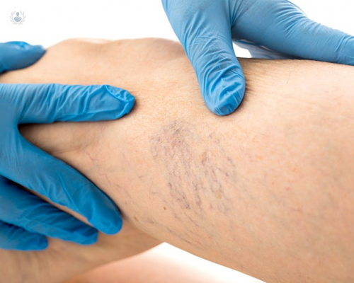 tratamiento-de-las-varices-con-radiofrecuencia-y-espuma-esclerosis-con-espuma imagen de artículo