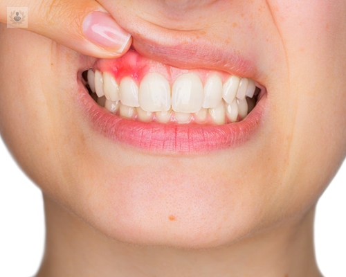 sintomas-y-tratamiento-de-la-periodontitis imagen de artículo