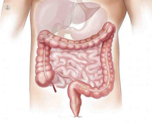 los-diverticulos-de-colon-que-son-y-como-se-previenen imagen de artículo