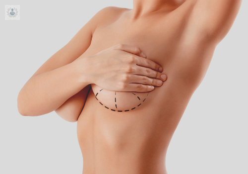 Avances en Mamoplastía de aumento: un implante para cada mujer