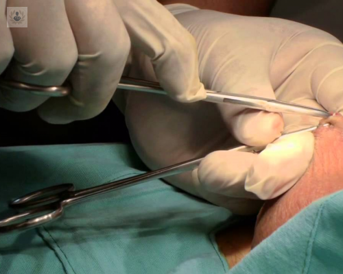 vasectomia-sin-bisturi-sin-agujas-y-sin-dolor imagen de artículo