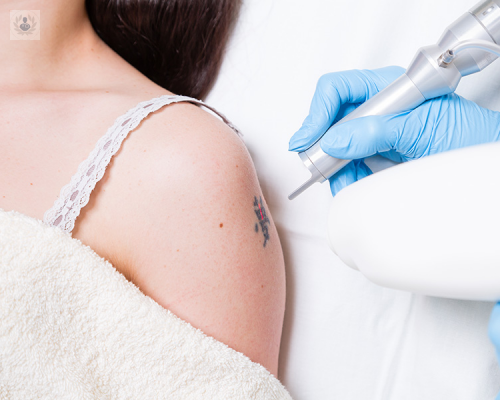 eliminar-manchas-y-tatuajes-con-laser imagen de artículo