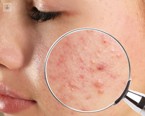 la-influencia-de-la-dieta-en-el-acne imagen de artículo