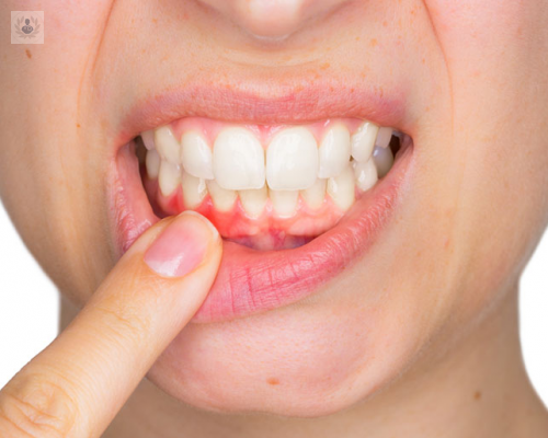 Síntomas, tratamiento y efectos de las enfermedades periodontales
