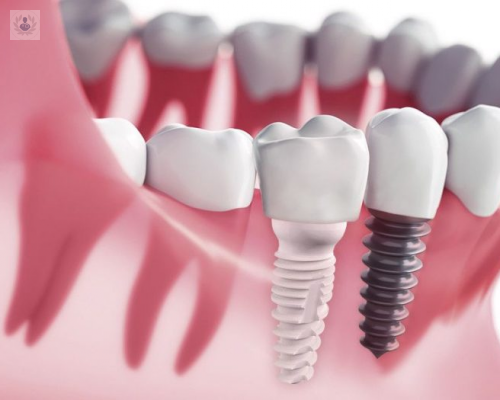 Los Implantes Dentales