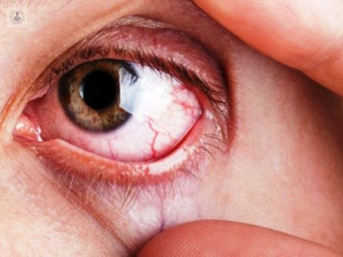 Glaucoma, una ceguera silenciosa