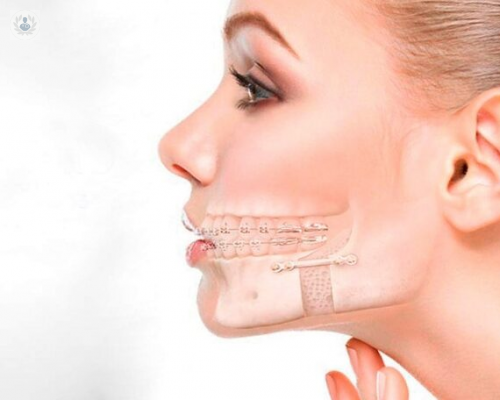 la-cirugia-ortognatica imagen de artículo