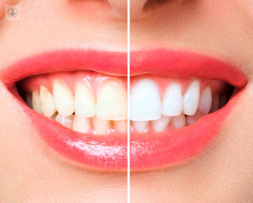 El Blanqueamiento Dental ayuda a eliminar las manchas superficiales