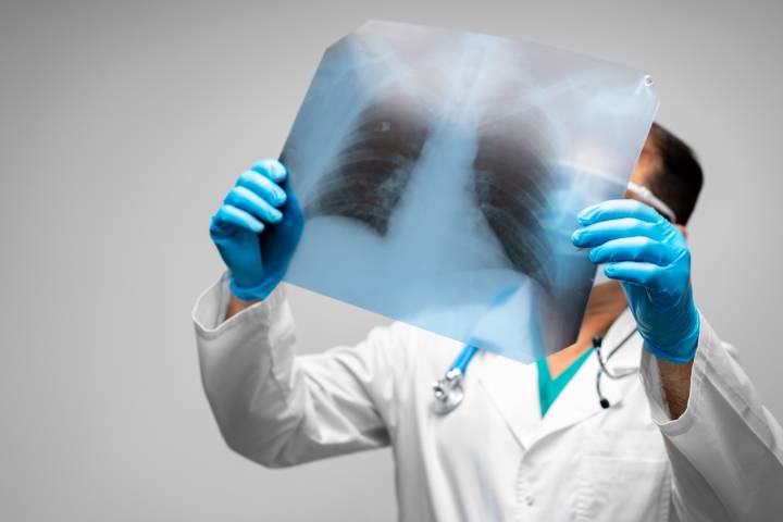 el-nodulo-pulmonar-el-diagnostico-y-sus-causas imagen de artículo