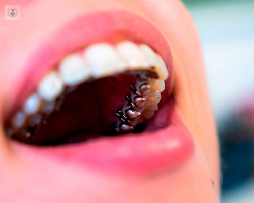 ortodoncia-lingual-la-unica-tecnica-de-ortodoncia-totalmente-invisible imagen de artículo