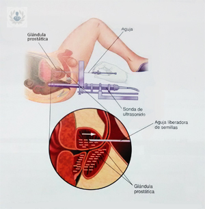 la-braquiterapia-una-radiacion-que-combate-el-cancer-de-prostata-desde-dentro imagen de artículo