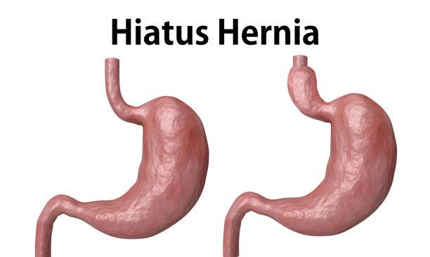 sabes-todo-lo-necesario-sobre-la-operacion-de-hernia-de-hiato imagen de artículo