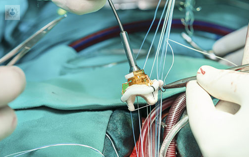 Cirugía de las Válvulas Cardíacas sin Utilizar Prótesis Artificiales