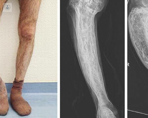 nuevos-sistemas-para-reparar-una-lesion-o-deformidad-osea imagen de artículo