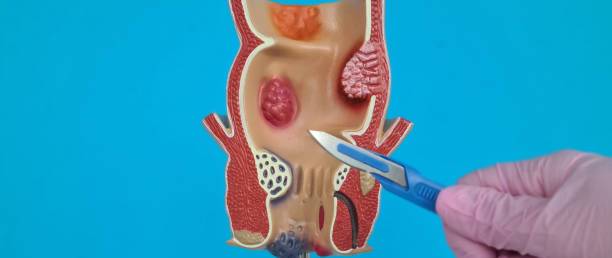 fistula-perianal-que-es-y-que-sintomas-tiene imagen de artículo