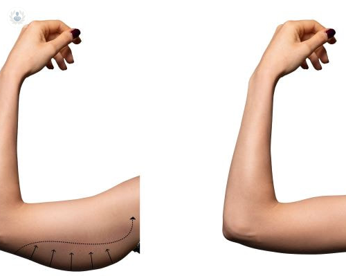 braquioplastia-el-lifting-que-acaba-con-la-flacidez-de-los-brazos imagen de artículo