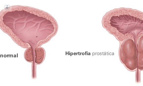 hiperplasia-benigna-de-prostata-el-uso-de-laser-verde-como-cirugia imagen de artículo