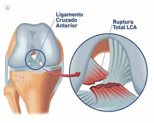 reconstruccion-del-ligamento-cruzado-anterior imagen de artículo