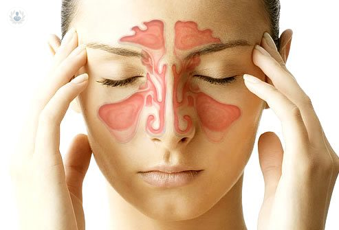 Sinusitis: los síntomas y su tratamiento