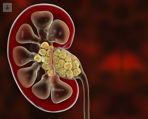 piedras-en-el-rinon-o-calculos-renales imagen de artículo