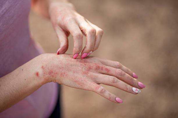 dermatitis-atopica-el-asma-de-la-piel imagen de artículo