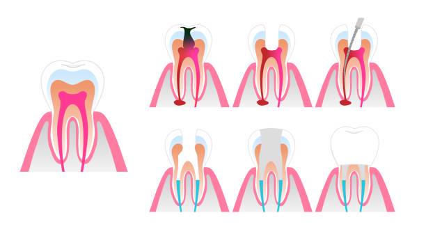 que-es-una-endodoncia imagen de artículo