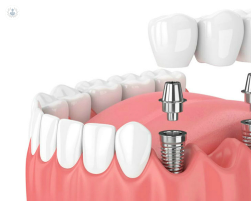 Implantología Dental Guiada por Ordenador