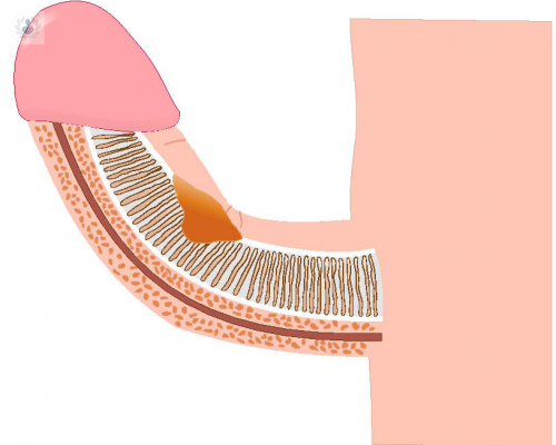 que-es-la-enfermedad-de-peyronie imagen de artículo