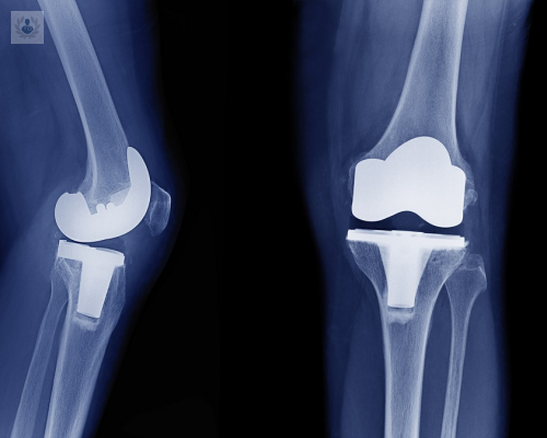 artoplastia-de-rodilla imagen de artículo