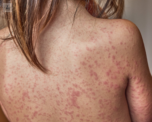 psoriasis-que-es-y-sus-causas imagen de artículo