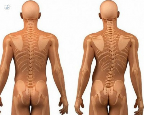 escoliosis-sintomas-y-tratamiento imagen de artículo