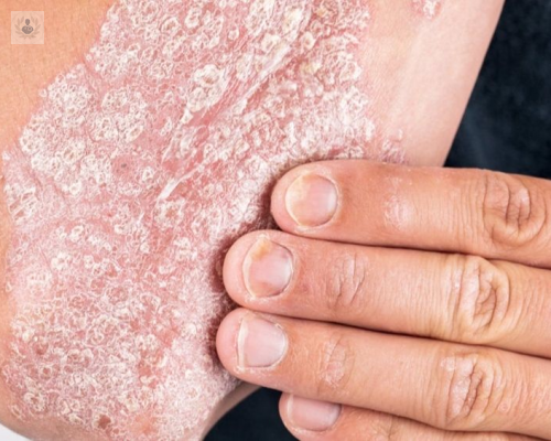 psoriasis-tipos-y-tratamientos imagen de artículo