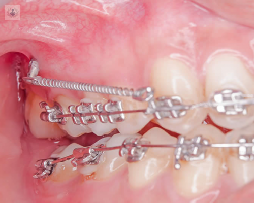 microtornillos-en-ortodoncia imagen de artículo