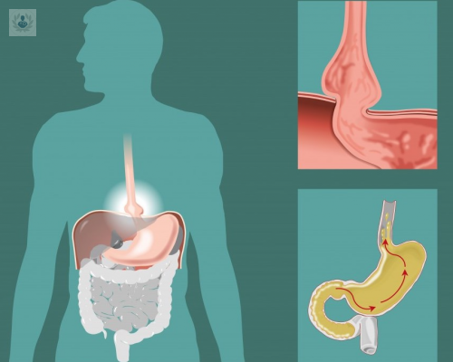 la-dieta-adecuada-para-la-hernia-de-hiato imagen de artículo