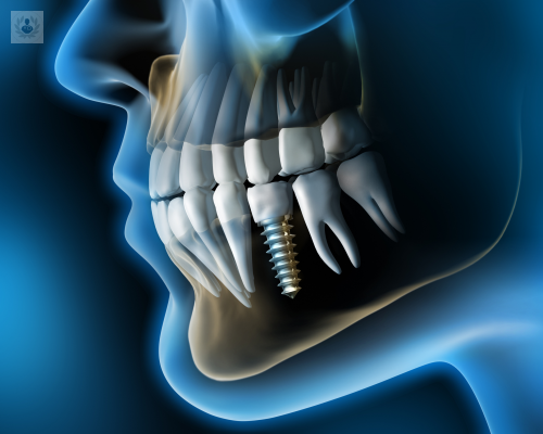 implantes-dentales imagen de artículo