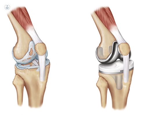protesis-total-de-rodilla imagen de artículo