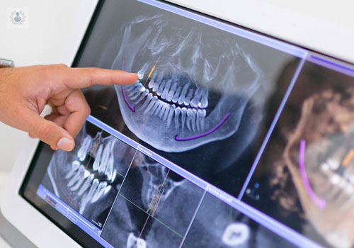 planificacion-y-cirugia-guiada-en-implantologia imagen de artículo