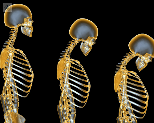 osteoporosis-de-tipo-i-y-osteoporosis-secundaria imagen de artículo