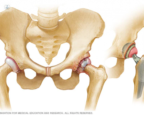 protesis-de-cadera imagen de artículo
