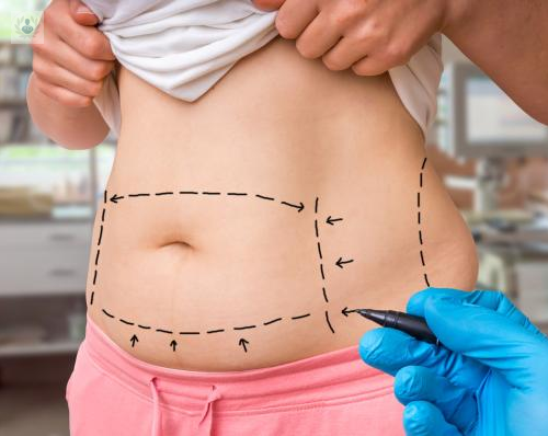 liposuccion-la-tecnica-para-eliminar-grasa-de-forma-permanente imagen de artículo